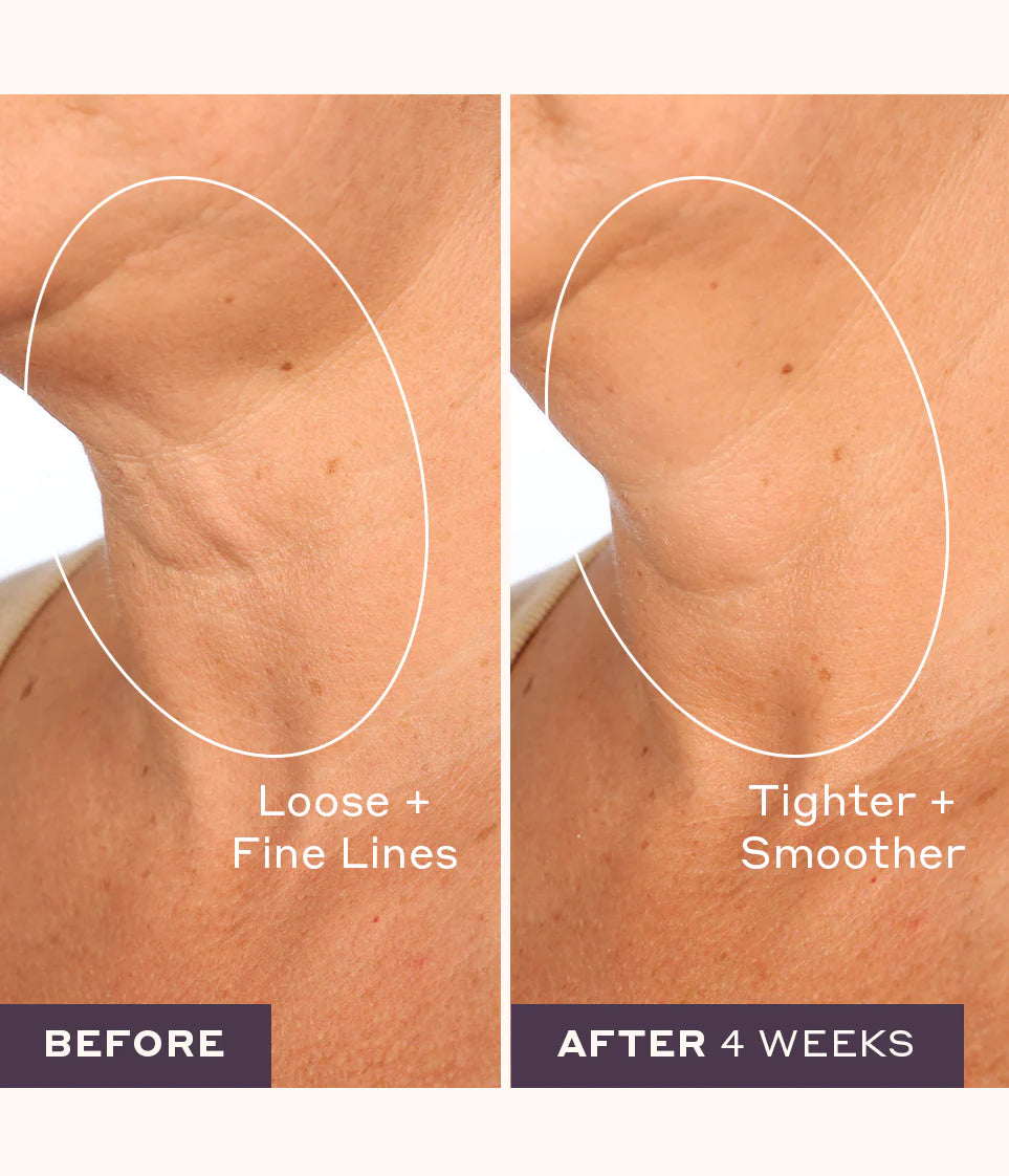 Before and after comparison of a woman’s neck and décolleté area showing the effects of using Womaness Let’s Neck neck and décolleté serum. The left side labeled 'Before' shows visible skin texture and fine lines, while the right side labeled 'After' shows smoother, firmer-looking skin with a reduction in visible lines, illustrating the product’s impact over time.